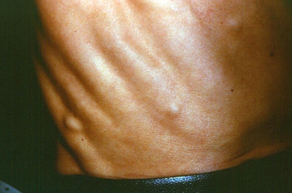Clinical presentation Most common is solitary or small grouped nodule(s), firm, often rapidly growing Erythematous patch (inflammatory