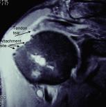 MRI of tendon tear The First Steps of Treatment NSAIDs (non-steroidal anti-inflammatory drugs), physical therapy referral and a home exercise program are typically recommended as the initial