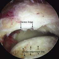 An arthroscope is first used to visualize the tear, assess the damage, and perform a bursectomy (removal of the inflamed bursal sac) and an acromioplasty a procedure that removes bone spurs from
