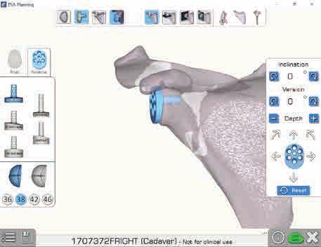 PREOPERATIVE PLANNING Figure 13 Figure 14 There are different ways to visualize the bone. These may be toggled using the menu across the top.