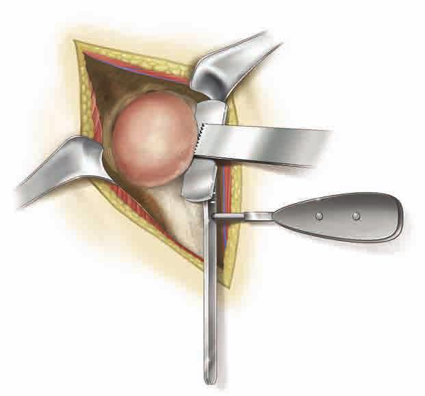 inferiorly with a small blunt retractor placed just inferior to the capsule. The capsular releases should be performed to allow 90 of external rotation.