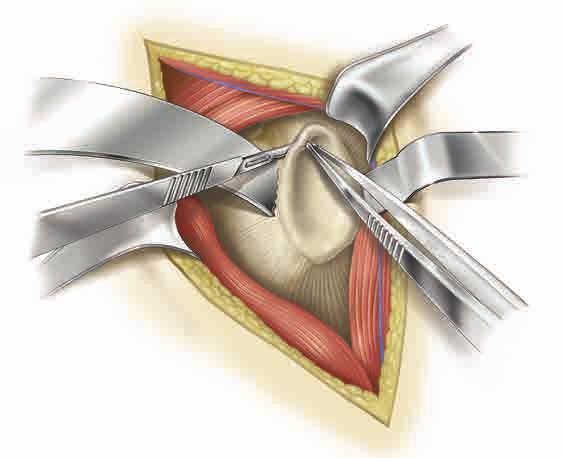 Figure 40 Figure 42 Figure 41 Place a retractor along the posterior border of the glenoid face (Figure 40) and retract the humeral head to expose the anterior glenoid edge.