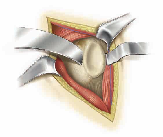 Carefully remove the hyaline cartilage from the glenoid surface using a Cobb elevator, ring curette, or comparable removal tool.