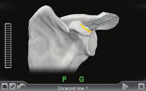 Figure 51c: Line anterior of coracoid block Figure 51e: Four points on glenoid face: superior, inferior, anterior, posterior Figure 51d: Line posterior of coracoid block Figure 51f: Paint
