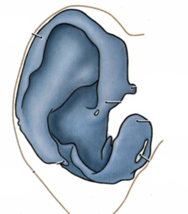 Antihelix Lobule Cartilage does not extend into lobule - Can