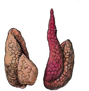 Anatomy: Thyroid Gland Normal variations common Right lateral lobe Left lateral lobe Pyramidal lobe - when