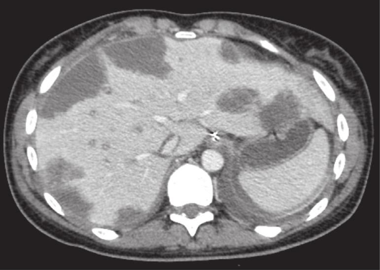 resection Figure 1: (a) Portal venous phase contrast-enhanced CT shows several small hypoattenuating lesions with slight peripheral enhancement.