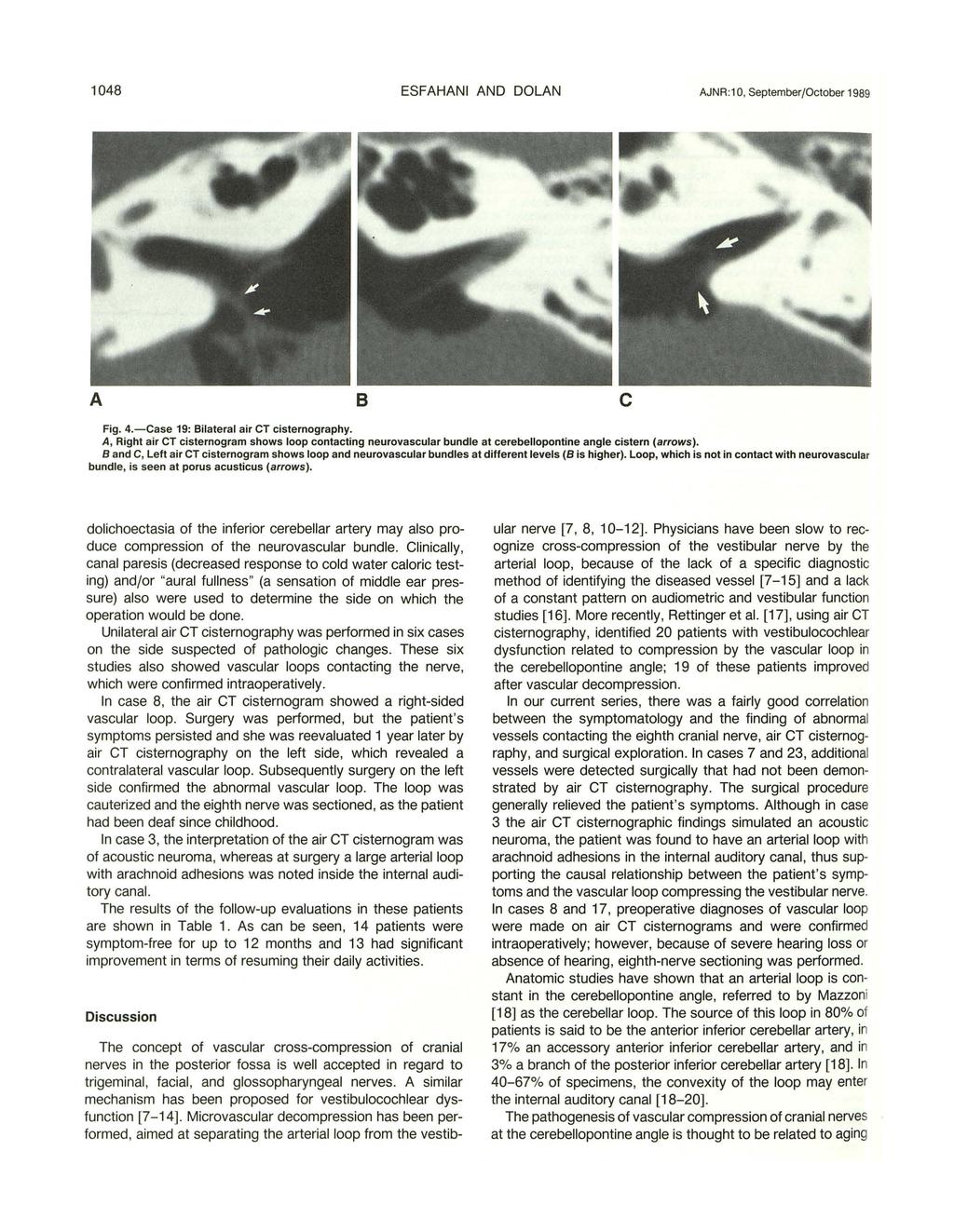 1048 ESFAHANI AND DOLAN AJNR:1 0, September/October 1989 A 8 c Fig. 4.-Case 19: Bilateral air CT cisternography.