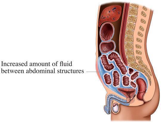 Ascites Retention of fluid, proteins, and electrolytes in