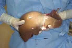 Transplant Recommended for people who have end-stage liver disease (ESLD) A surgical