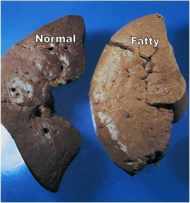 Definitions Steatohepatitis Fatty liver disease that has resulted in