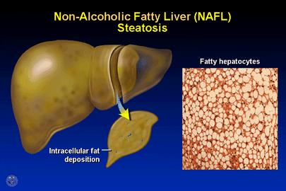 liver disease that has resulted in inflammation of the liver in the