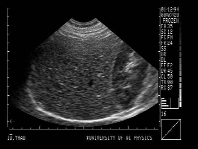 Optional US: Ultrasound