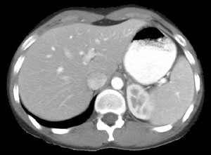 NAFLD -- diagnosis Normal CT Liver = spleen Steatosis Liver<spleen Severe fatty infiltration; liver<spleen Fatty infiltration results in a decrease in attenuation (Houndsfield units) <40 HU