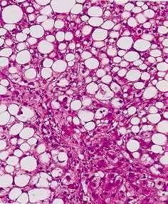 NASH HISTOLOGY NASH: H and E stain,