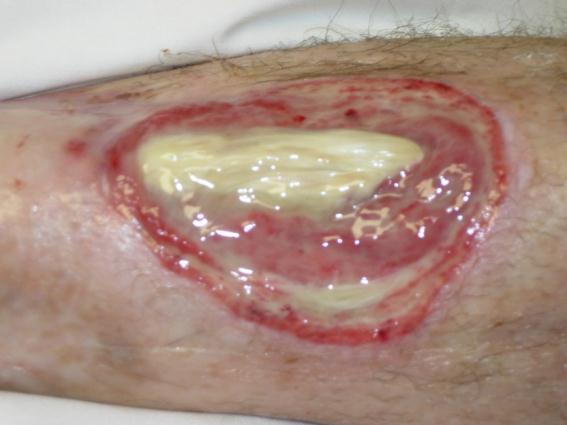 wound haemostasis