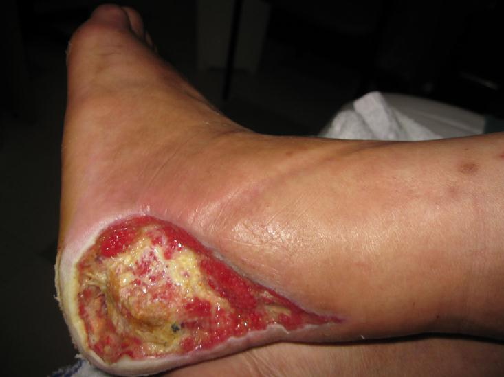 Complex Diabetic Foot Potential damage