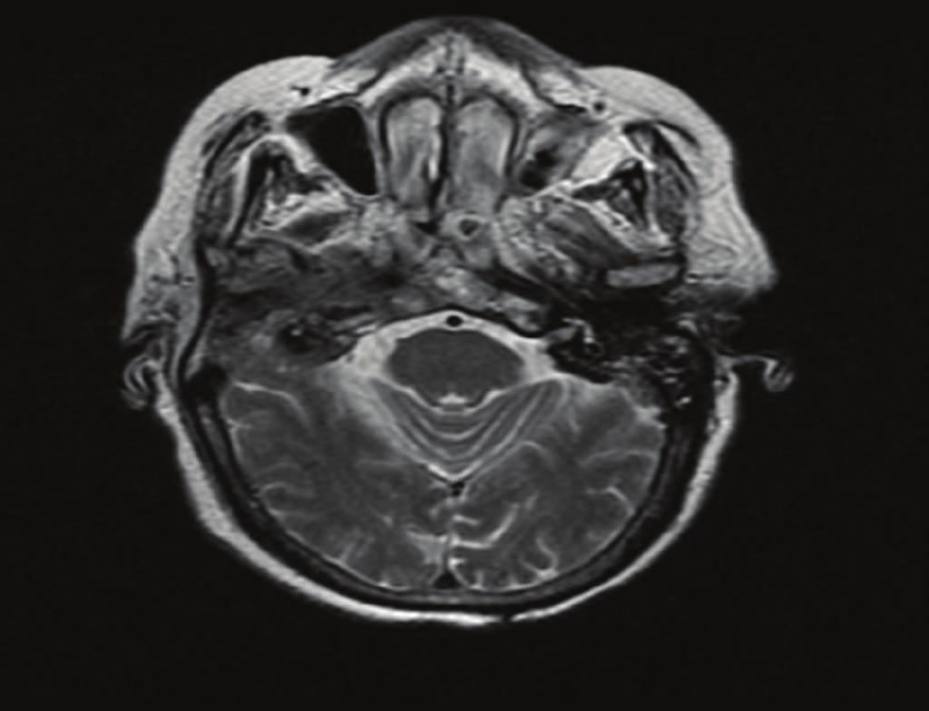 Figure 2: Neck soft tissue Magnetic resonance imaging showing heterogeneous signal abnormality and enhancement centered about the right external auditory canal and middle ear region.