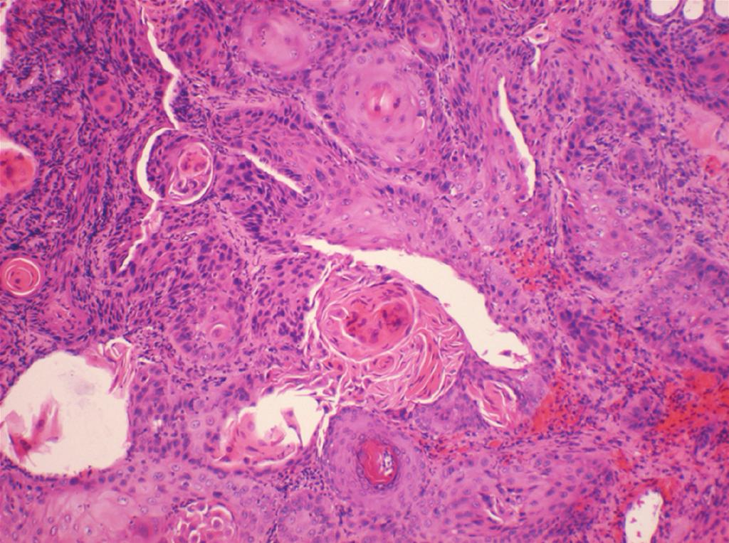Figure 3: Showing well-diﬀerentiated squamous cell carcinoma, characterized by sheets of cells with large cells with pleomorphic, hyperchromatic nuclei and individual cell keratinization, and keratin