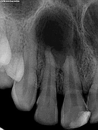 periapical cyst secondary to trauma. Treatment plan was decided and informed consent was obtained from the patient. Access cavity preparations were done on 12, 11 and 21 under rubber dam isolation.
