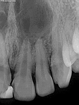 Cleaning and shaping was done using hand K files (Sybron Endo). 5.25% sodium hypochlorite and saline were used as intra canal irrigants.