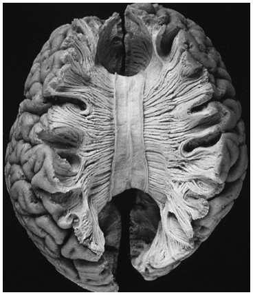 Divided Brain C2:65 - Split Brain Condition in which two hemispheres of brain are isolated by cutting connecting fibers Corpus Callosum: