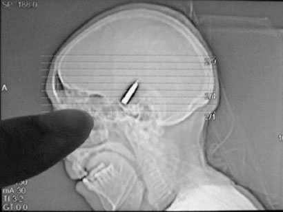 Experimentally caused destruction of brain tissue - Strokes - Gun shots - Auto accidents - Disease - Surge