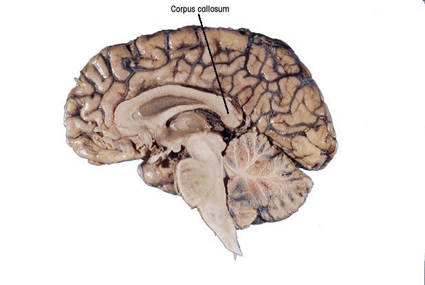 Our Divided Brain Corpus callosum Corpus Callosum large band of neural