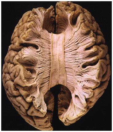Split Brain a condition in which the two hemispheres of the brain are isolated