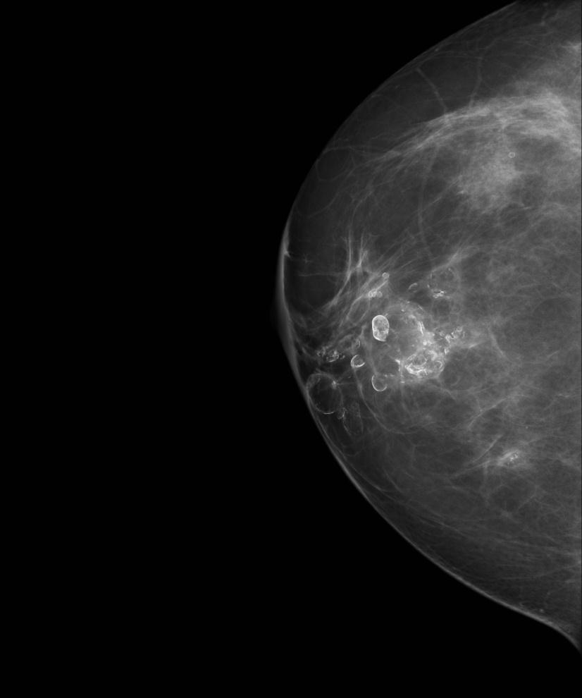 Aim Evaluate the mammographic appearances after BTM Frequency of additional