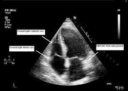 12/18/16 Screening for PAH: the echocardiogram The value of screening for PAH Results of a disease registry in France without screening, the majority of patients were diagnosed in WHO FC III or FC IV
