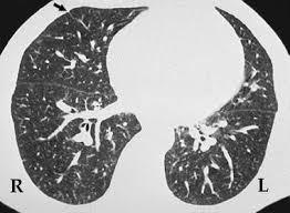 opacity *Enlarged central pulmonary arteries *Mosaic pattern of lung