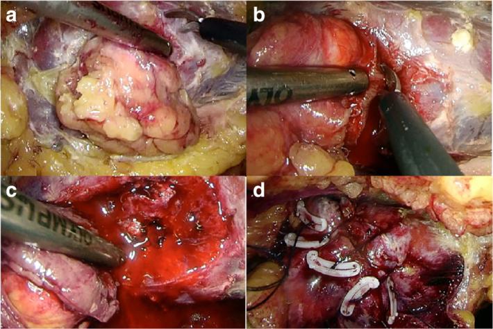 Wang et al. World Journal of Surgical Oncology (2016) 14:163 Page 3 of 6 Fig. 1 Surgical procedure for off-clamp laparoscopic partial nephrectomy.