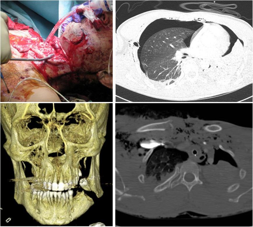 Scheyerer et al. Journal of Trauma Management & Outcomes (2015) 9:4 Page 2 of 9 Fig. 1 A 37-years-old patient who was hit by a pipe through the car windscreen.