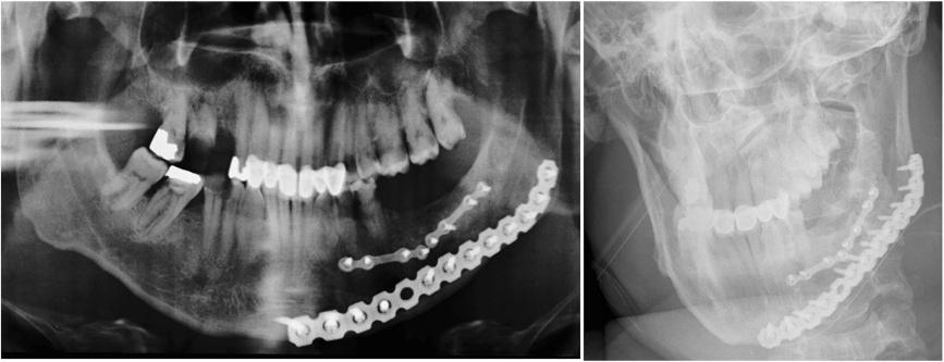 (serial rib fracture, lung contusion, clavicles fracture, soft tissue emphysema). The initial treatment of the mandibular fracture within the trauma room included provisional bony stabilization.