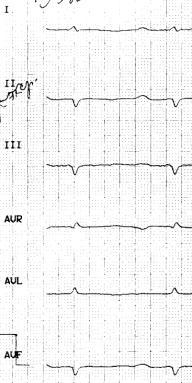 ECG in 45 y.o. patient with TTR amyloidosis.