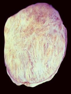 calcifications Paucicellular background fibroblastic proliferation Appears to be a