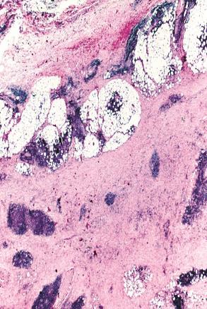 disease Potential Etiological Factors for Fibrosing Mediastinitis Fungal Infections Histoplasmosis