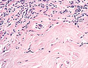 LARGE-CELL NON-HODGKIN LYMPHOMA OF THE