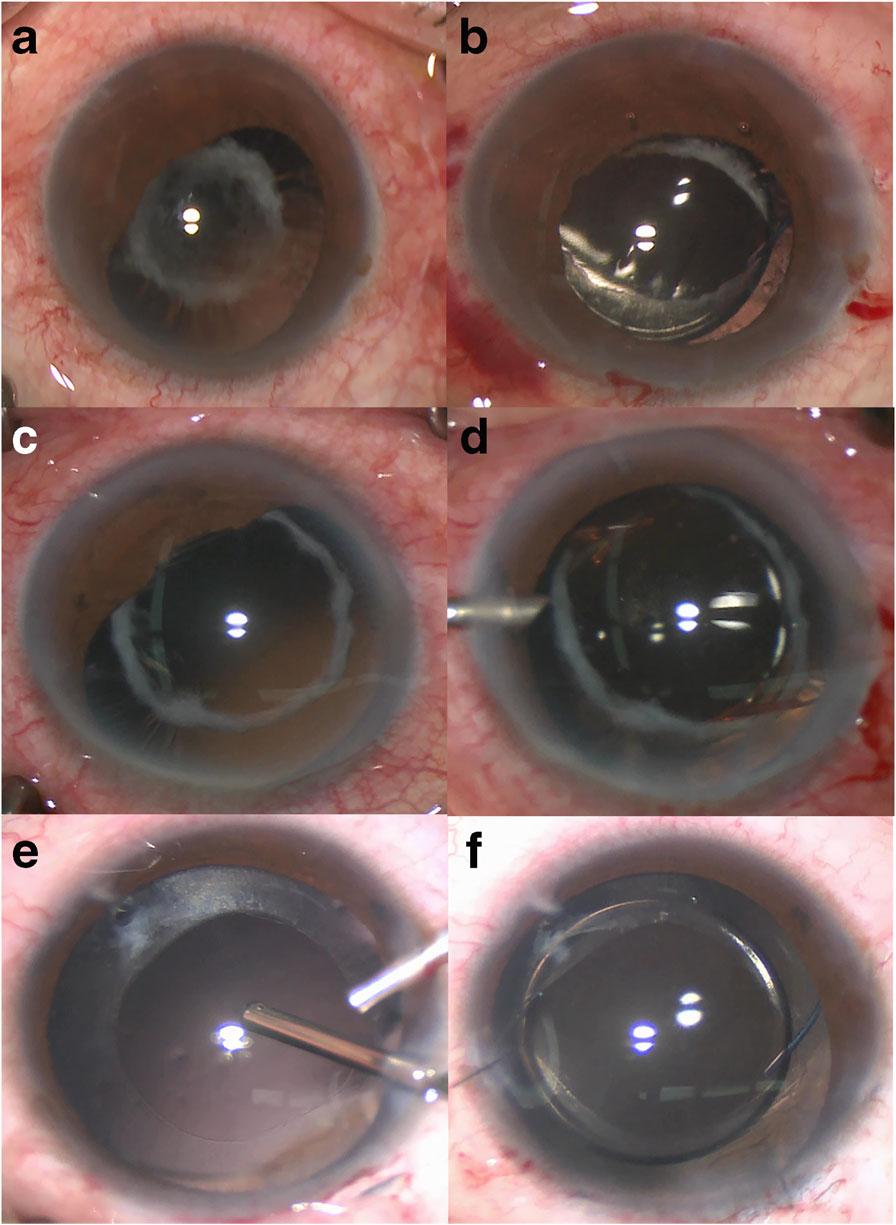 Tian et al. BMC Ophthalmology (2018) 18:84 Page 2 of 7 curvilinear capsulorhexis opening [7].