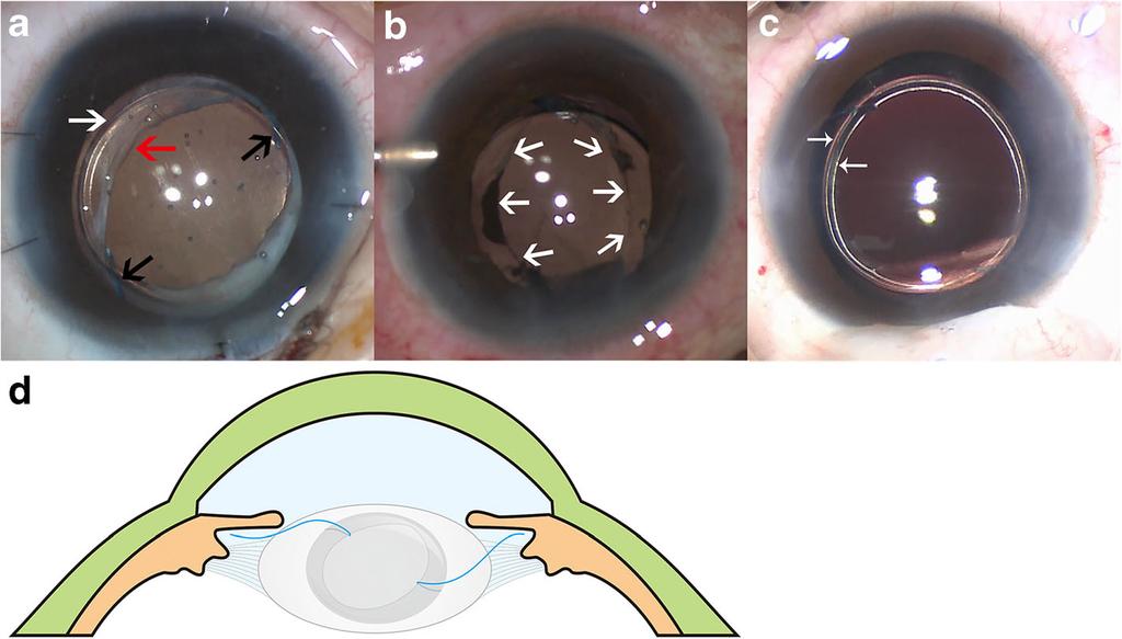 Tian et al. BMC Ophthalmology (2018) 18:84 Page 3 of 7 solution (Alcon, Laboratories, Inc) was inserted into anterior chamber through infratemporal corneal incision.