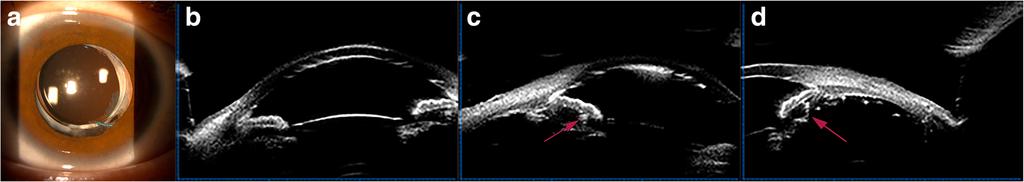 Tian et al. BMC Ophthalmology (2018) 18:84 Page 5 of 7 Fig. 4 A 10 years old male (Case 17), lensectomy and pans plana vitrectomy were performed because of traumatic macular hole.
