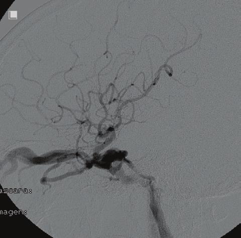 Endovascular Treatment of Intracranial Posttraumatic Lesions ssessing arteriovenous fistulas, dissections, and aneurysms.
