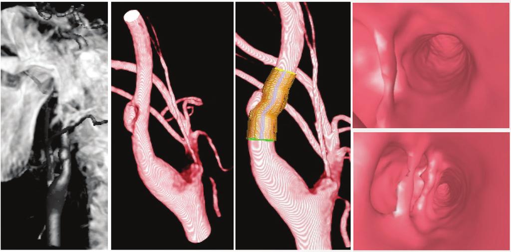 detailed four-vessel angiogram including visualization of the circle of Willis pattern with and without carotid compression is mandatory to plan an accurate endovascular treatment.