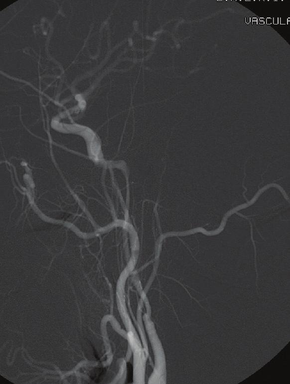 Sometimes, a bilateral carotid cavernous shunt is found. Embolization (Figure 2) allows access to the CCF through direct arterial access via the IC.
