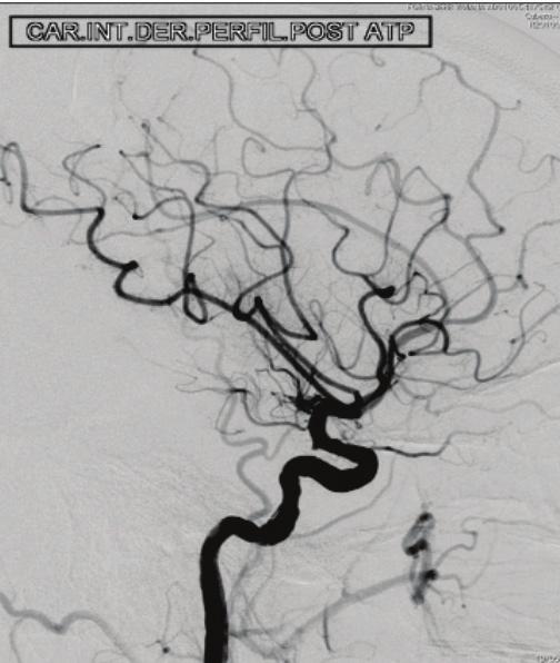 The right IC was permeabilized, and the image of the thrombus in the middle cerebral artery is viewed (C).
