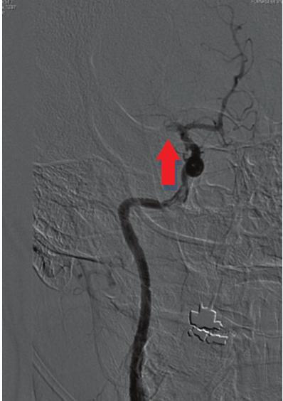 6 When a pseudoaneurysm is diagnosed, angioplasty is indicated in order to repair the vessel by flow diverter stent placement.