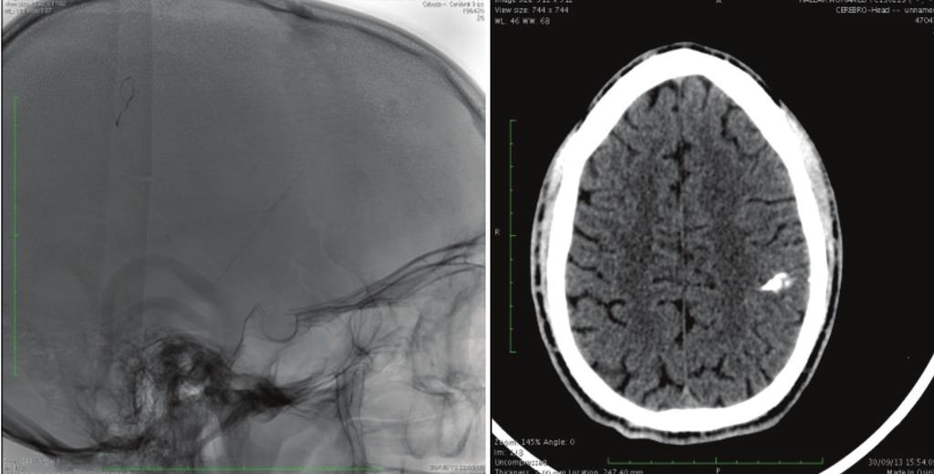 CT scan of the brain showed subarachnoid hemorrhage located in the convexity of the left parietal lobe (Figure 12).