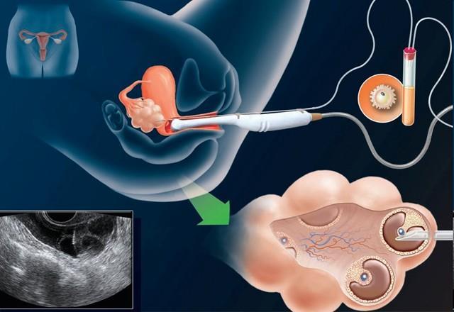 VAGINAL EGG COLLECTION Fallopian Tube Egg collection needle Ovary