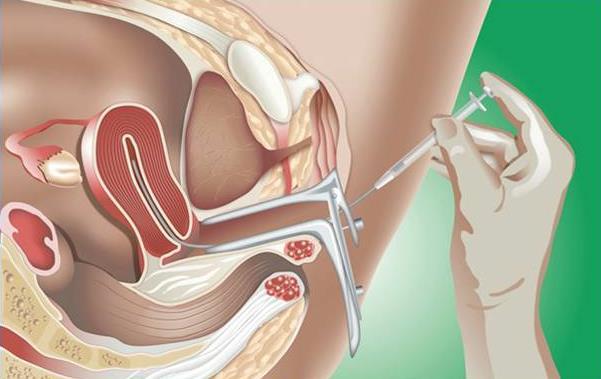 INTRAUTERINE INSEMINATION Uterus Cervix Prepared Sperm